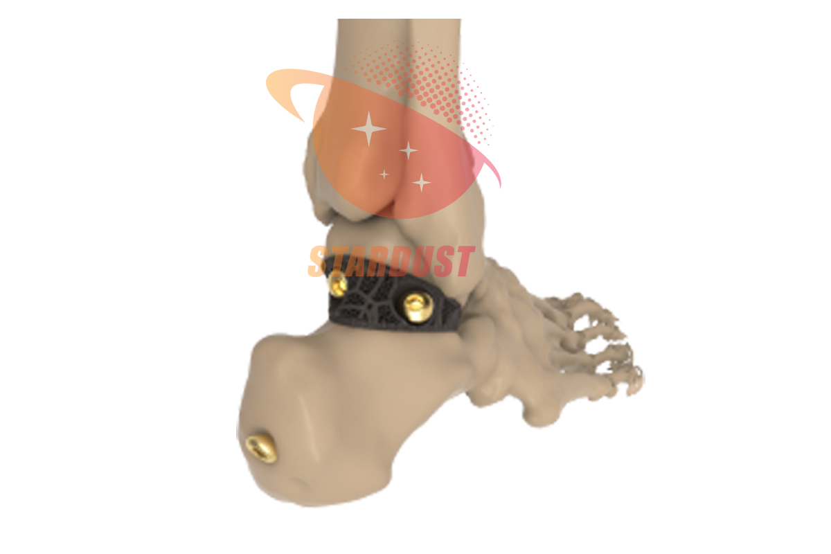 Introduction to the application of additive manufacturing technology in the field of orthopedic implants